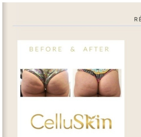Résultat avant après CelluSkin 1