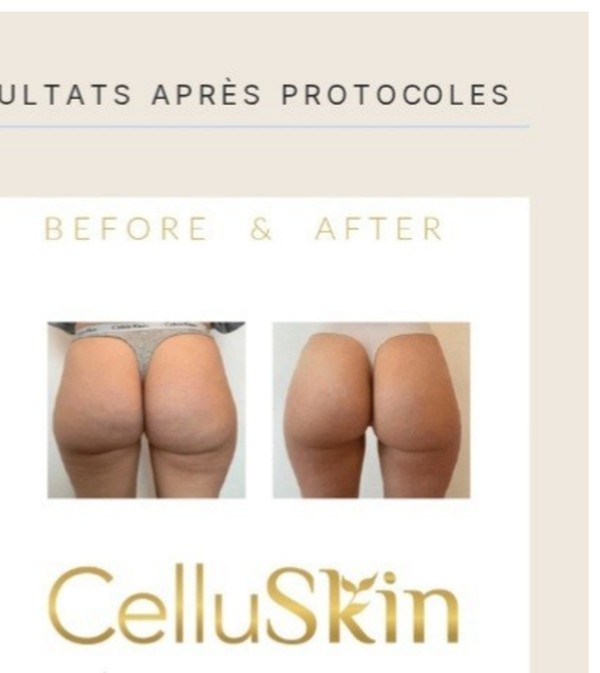 Résultat avant après CelluSkin 2