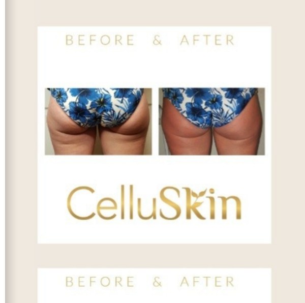 Résultat avant après CelluSkin 3