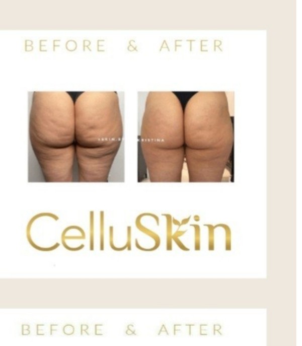 Résultat avant après CelluSkin 4