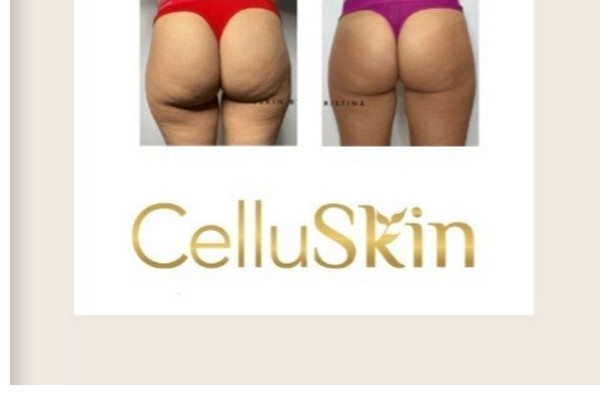 Résultat avant après CelluSkin 5