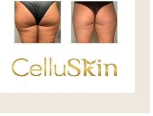 Résultat avant après CelluSkin 6