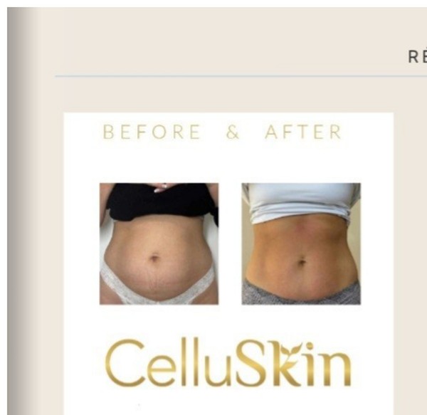 Résultat avant après CelluSkin 7