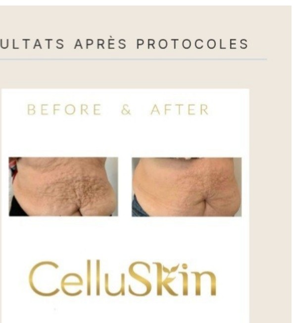 Résultat avant après CelluSkin 8