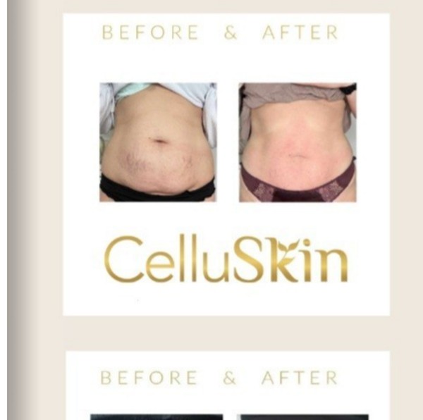 Résultat avant après CelluSkin 9